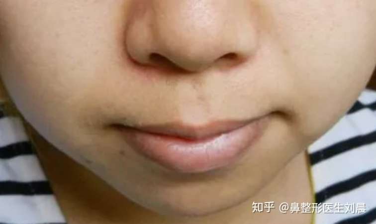 刘晨医生教你怎样养成一张干净的脸 知乎