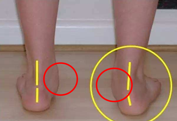 左脚低足弓,右脚正常足弓.左脚曾受伤,是否足弓塌陷?