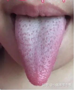 川崎病舌苔图片