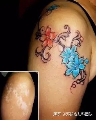 用纹身遮盖白癜风的白斑可以吗?