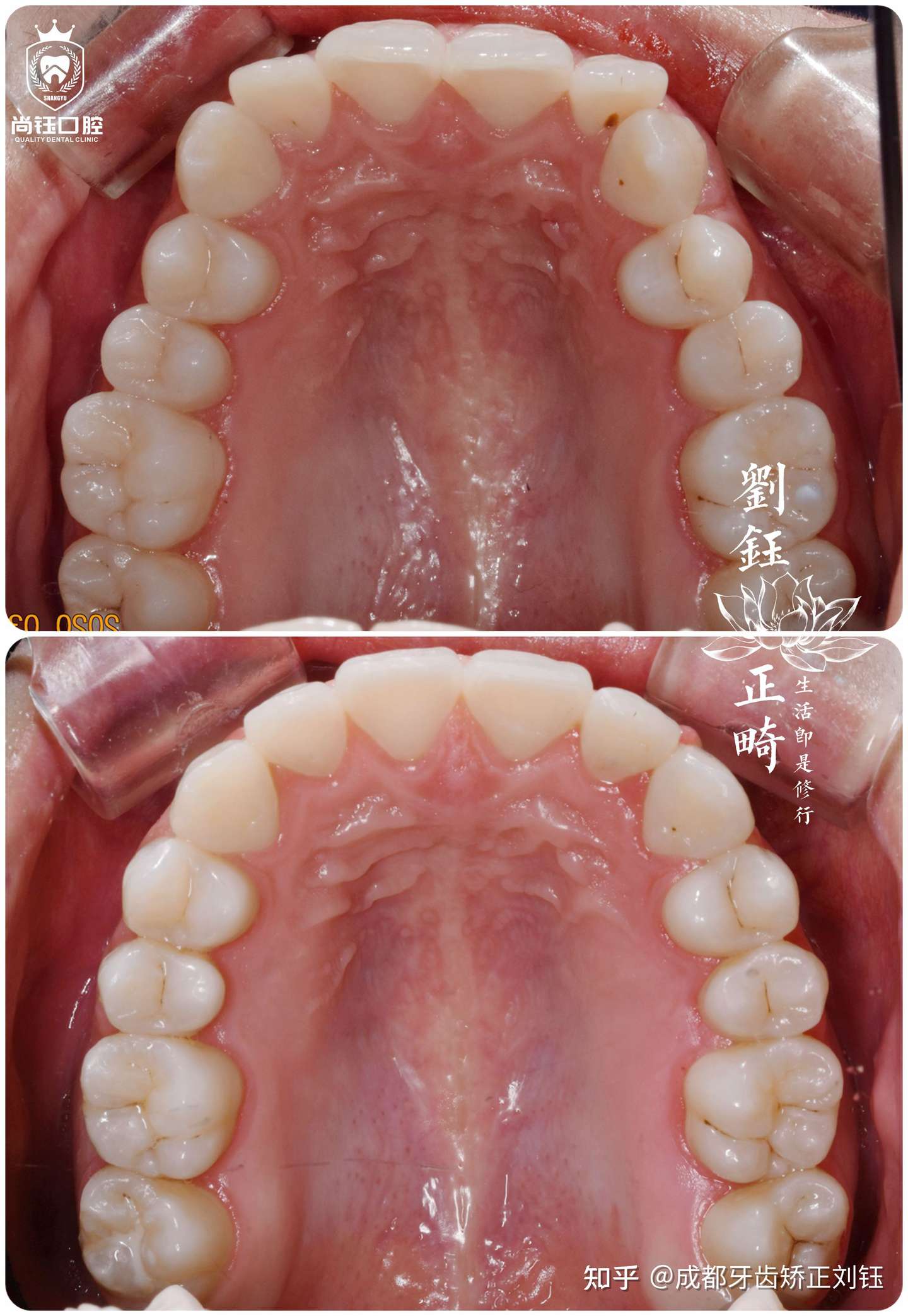 成都口腔正畸 暗黑系小仙女的隐形牙套毕业 知乎