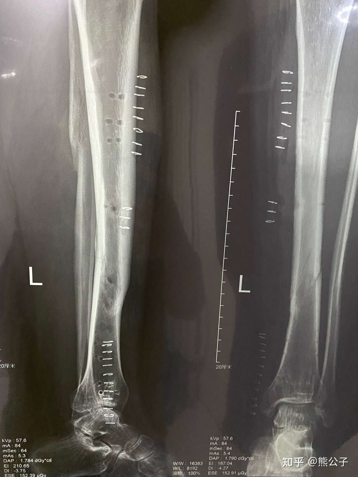 胫腓骨折3个月及取钢板后续 知乎