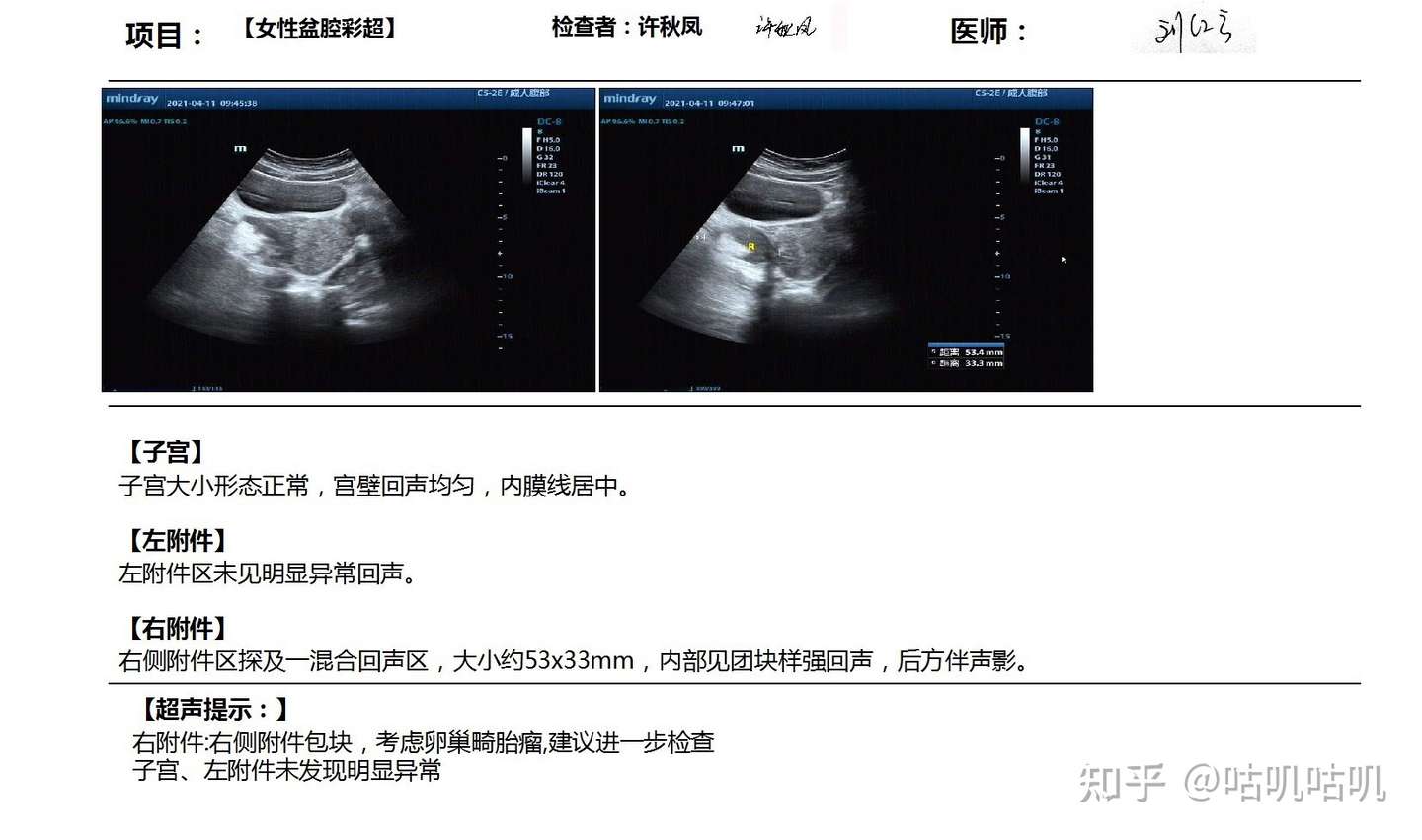 單孔腹腔鏡手術費用 Matteffer