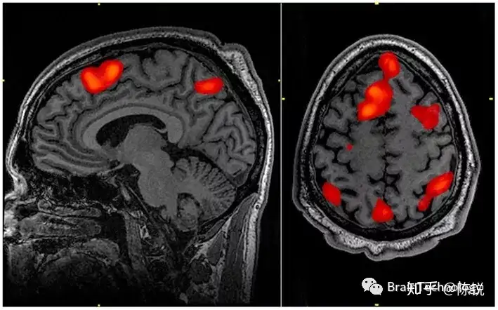 EEG vs MRI vs fMRI vs fNIRS - 知乎