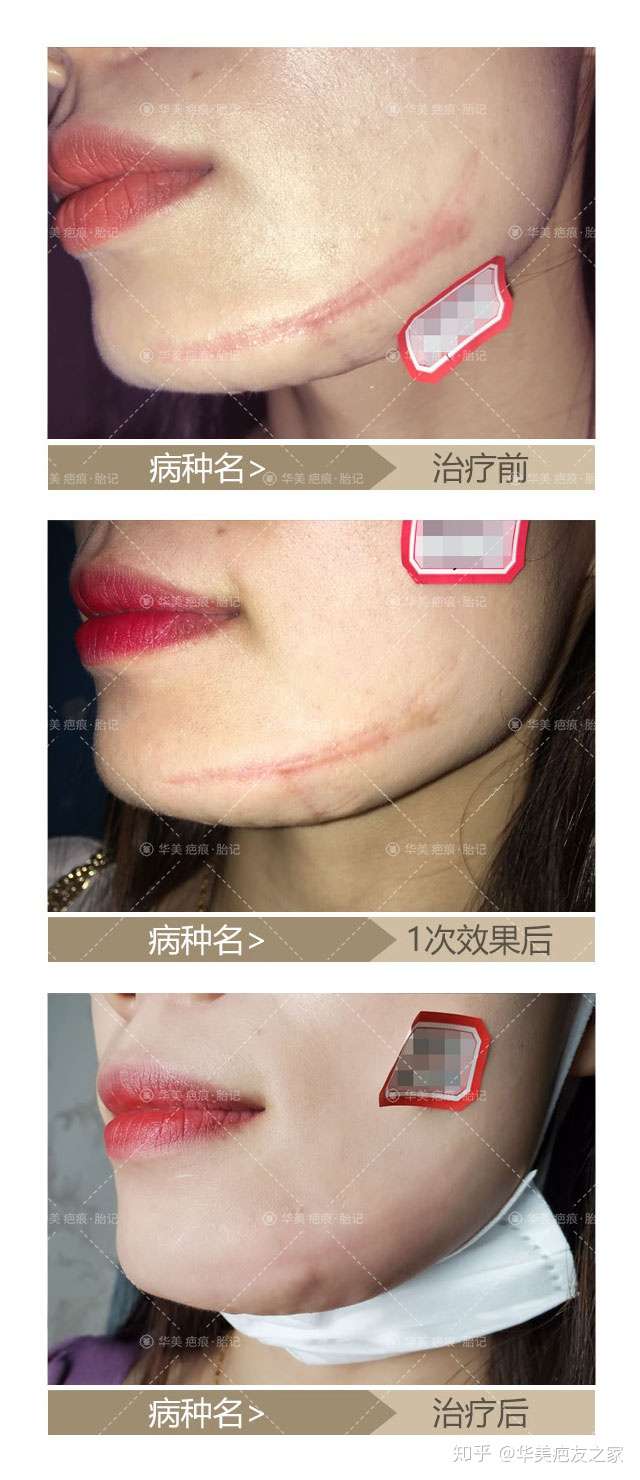 如何去除脸上疤痕