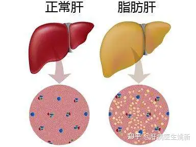 平常要定期檢查肝功能,如果出現肝功能異常就需要服用保肝抗炎藥物