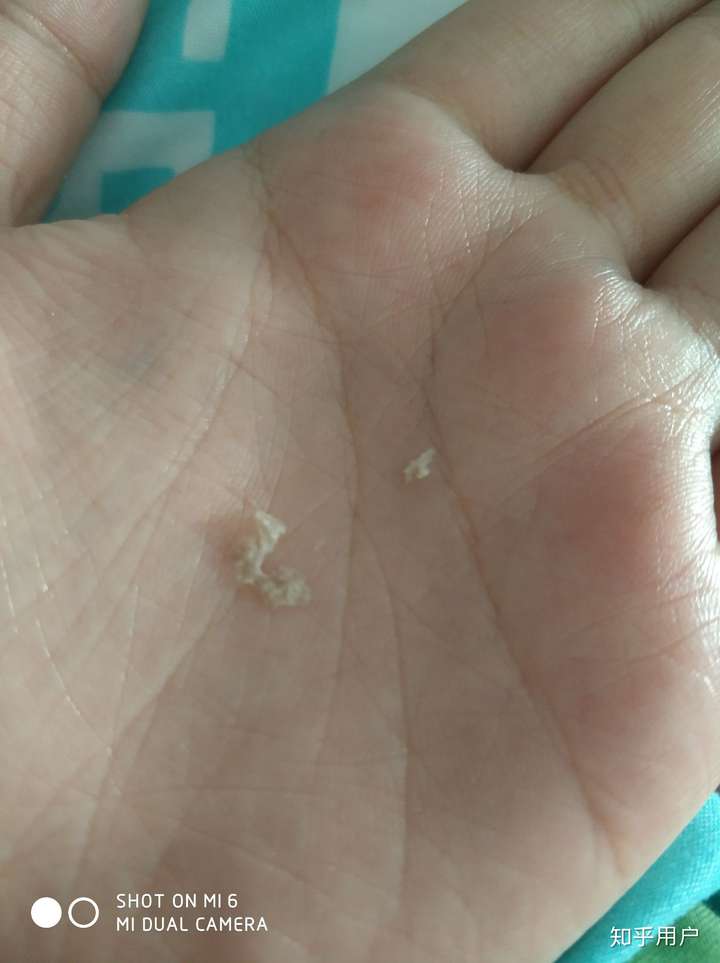 为什么抠下来大块的头皮屑会有瞬间的快感