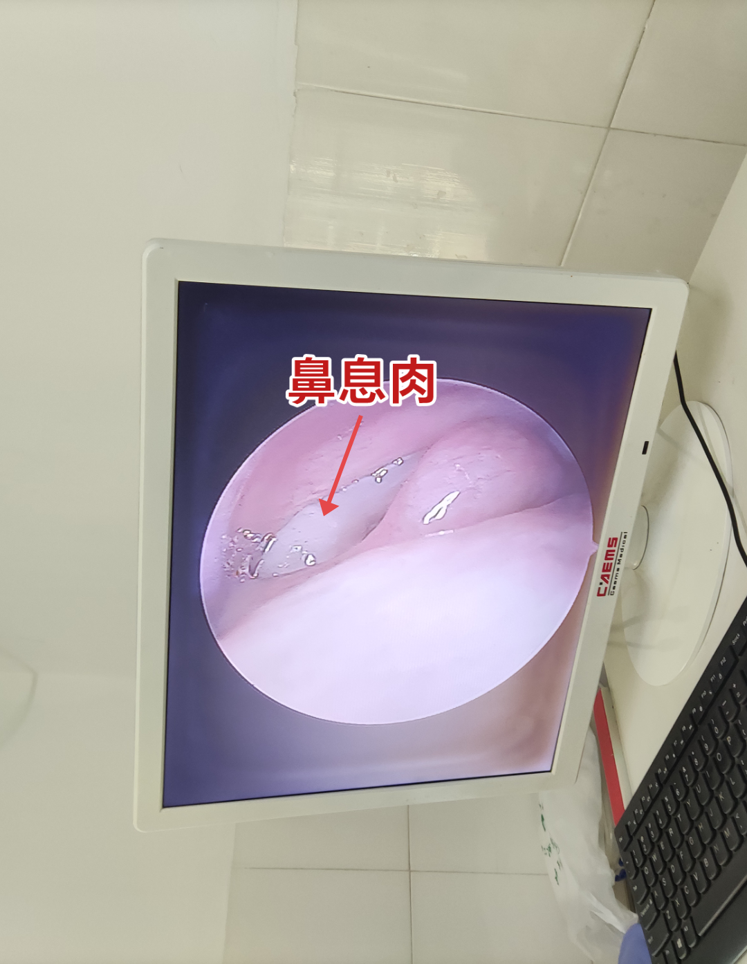 耳鼻喉陈医生 的想法: 鼻腔里的"荔枝肉" | 鼻息肉 - 知乎