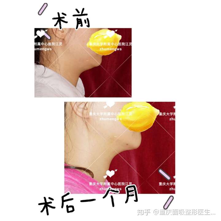 下巴祛痘小妙招_怎么消除下巴上的痘痘_双下巴怎么消除最有效的方法