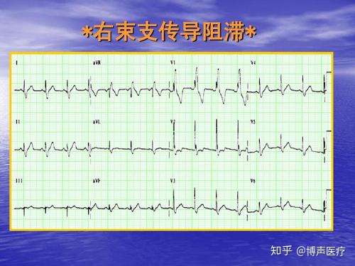 博声医疗 心电轴 心电轴右偏 知乎