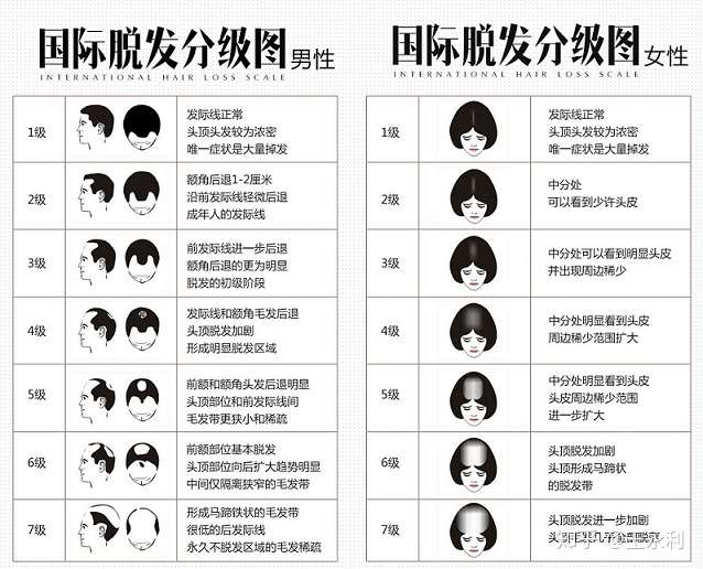 秃顶会遗传吗