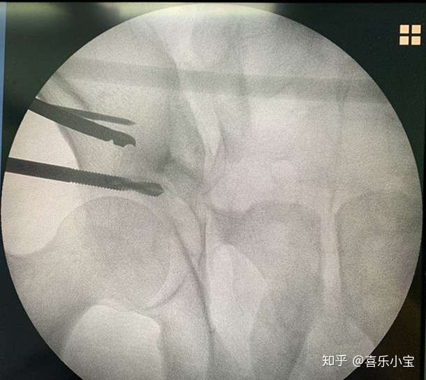 苏州地区首例c型骨盆骨折微创手术 知乎