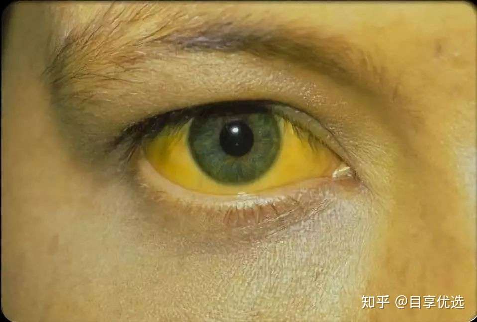 眼球发黄是怎么回事 知乎