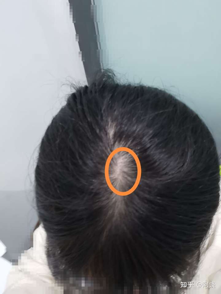 这样的头顶算脱发么?