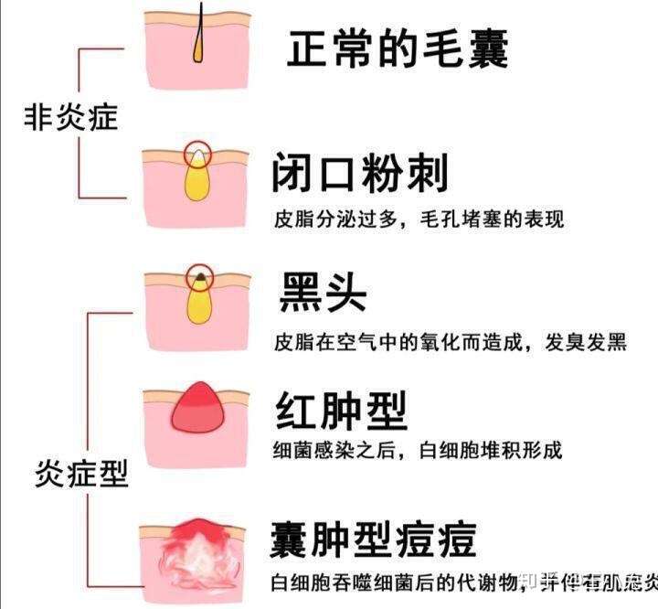 痘痘形成四步走