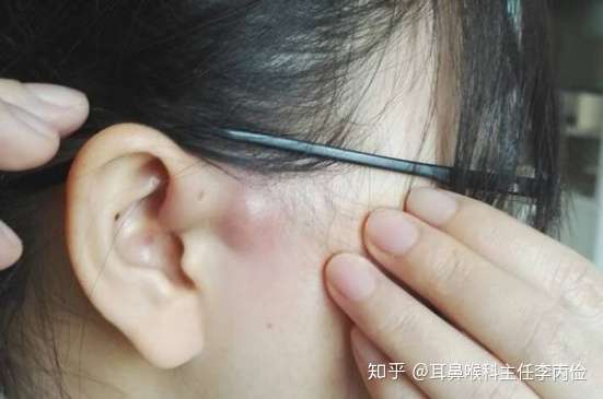 耳前瘘管：福兮祸所倚