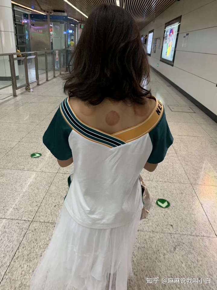 额头可以拔罐吗