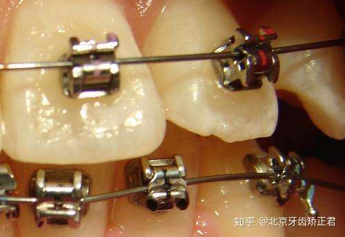 奥美科ormco冰晶自锁托槽和3m托槽哪个好价格大概是多少