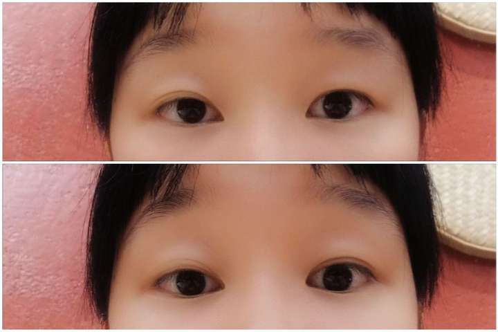 眼皮长得一单一双是一种怎样的体验?