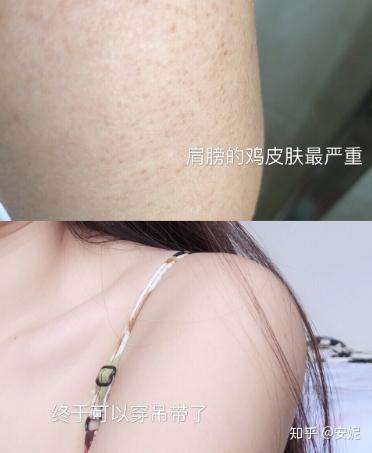 知乎激光治疗鸡皮肤(现在有人在研究根治鸡皮肤吗)