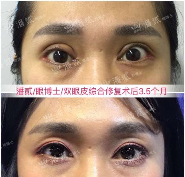 什么原因导致那么多双眼皮失败 知乎