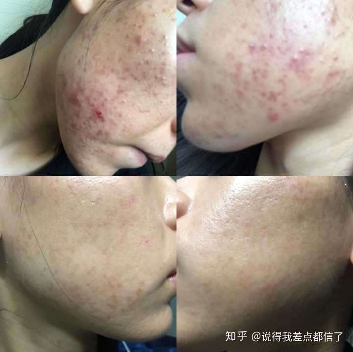 怎么样才能不长痘痘 知乎 怎么样才能不长痘痘 知乎