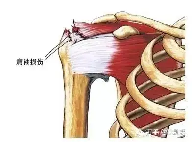 肩袖損傷如何康復治療