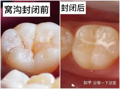 窝沟封闭 - 知乎