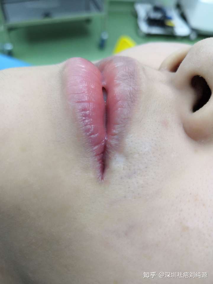 外唇凹陷疤痕可以修复吗?