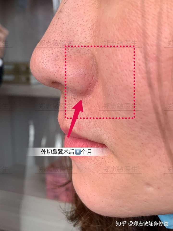 鼻翼缩小手术增生的几率很大吗?