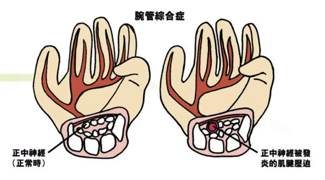 80 的白领学生党都中枪的 鼠标手 应该怎么破 知乎