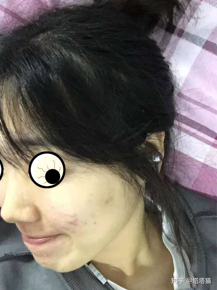 背后有黑色痘印可以用身体乳嘛(背后有黑色痘印可以用身体乳嘛图片) 背后有黑色痘印可以用身体乳嘛(背后有黑色痘印可以用身体乳嘛图片)