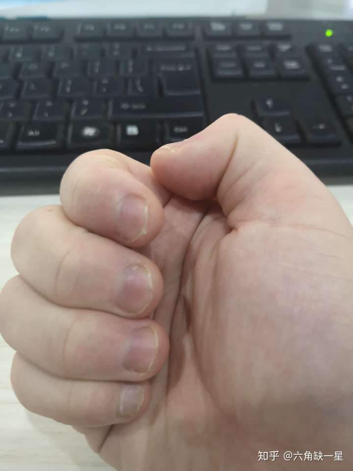 咬了10年了,还喜欢要指甲旁的肉,最近半个月没咬,真的憋的难受,手有