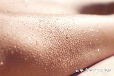 鸡皮肤要注意哪些事项(鸡皮肤要注意哪些事项和饮食)