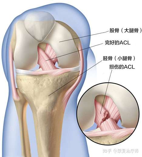 如何知道前交叉韧带是否损伤 知乎