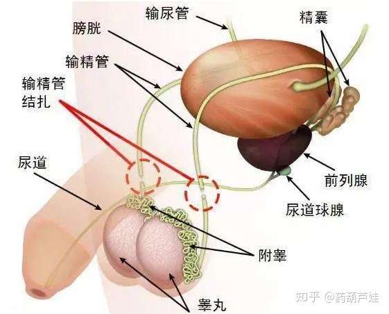 亲爱的 我去结扎了 知乎