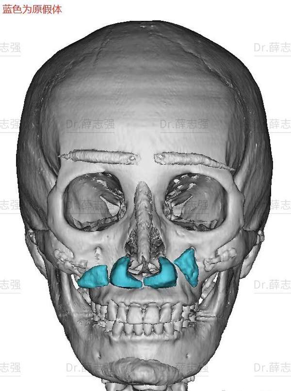 整形医生薛志强 的想法: 鼻修复与鼻基底修复结合案例 我们来从CT… - 知乎
