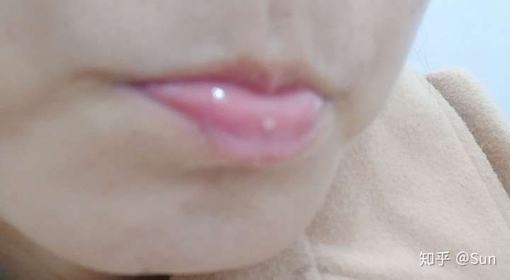 嘴唇上长了个类似脂肪粒的白点点求鉴定是嘴唇上