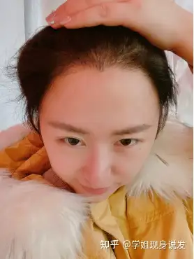 植发会越植越少吗(植发会减少头发总数吗)