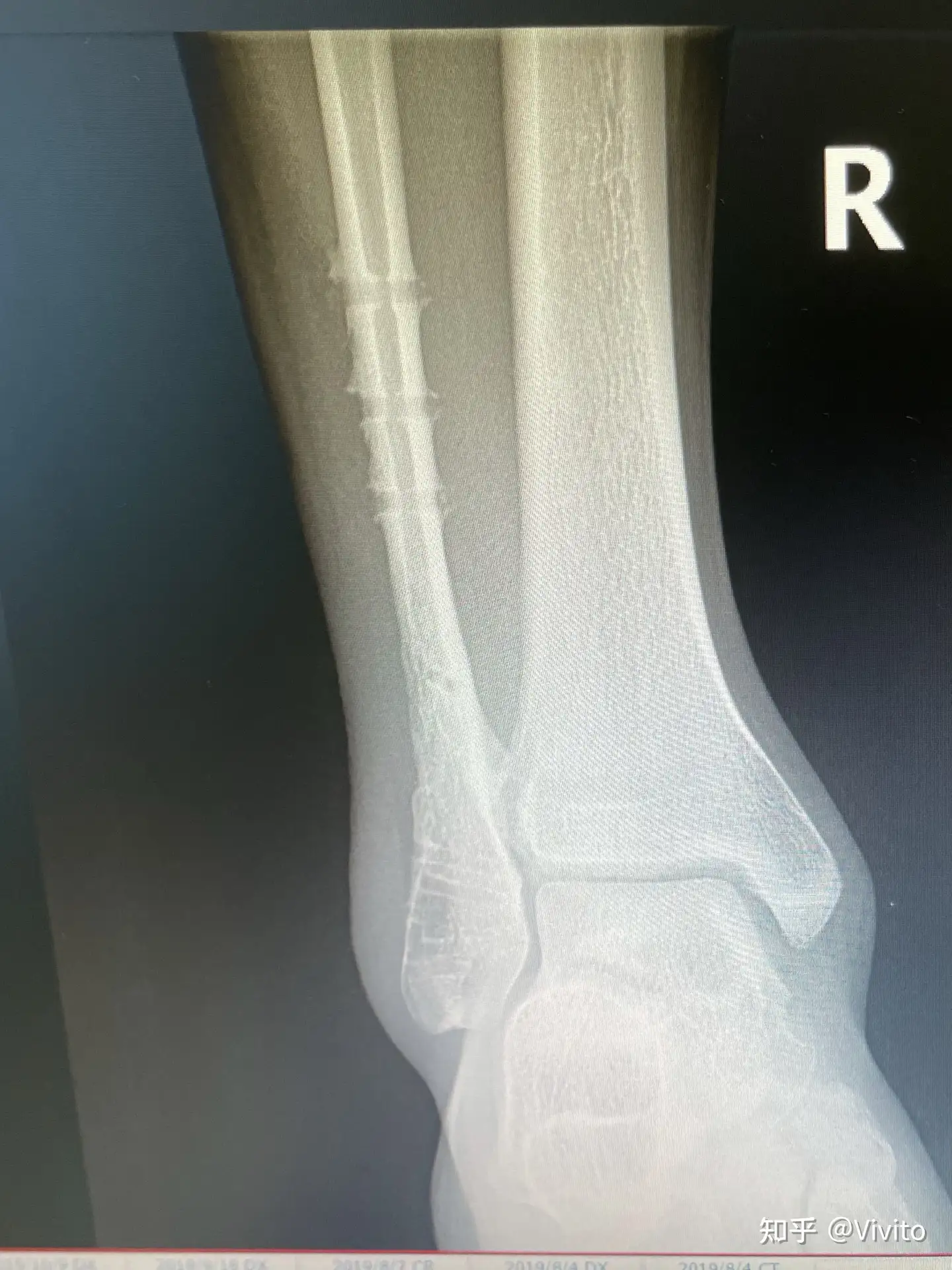 腓骨骨折康复记录 知乎