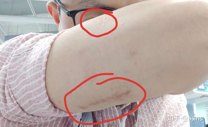 几年前去过医院两次都说是皮下脂肪瘤不用管它也没什么好的药治疗我想