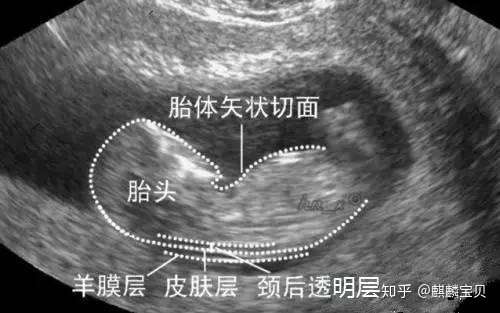 准妈妈不能错过的第一次排畸-NT插图(2) v2-4a8841bc550502f0785a2fde19393c5f_720w.jpg插图(2)