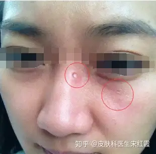 点痣后留疤怎么办这样治疗才有效