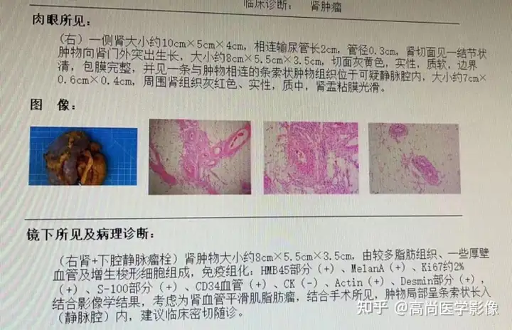 平时无不适，却检查出巨大肾错构瘤并局部凸入下腔静脉（肾错构瘤）