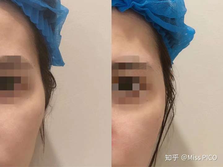 额头 太阳穴 面颊玻尿酸填充效果