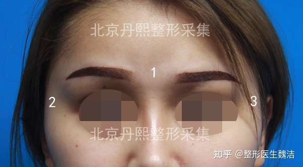 脂肪丰眉心联合假体丰眉弓手术改善衔接不自然 知乎