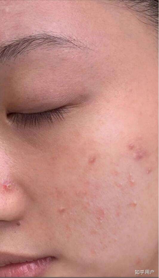 毛孔堵塞长闭口怎样疏通