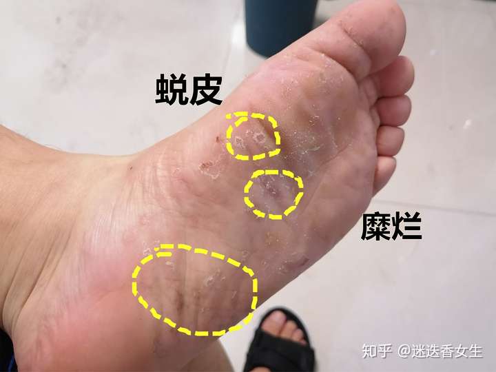 水疱型脚气水泡能扎破吗? - 知乎