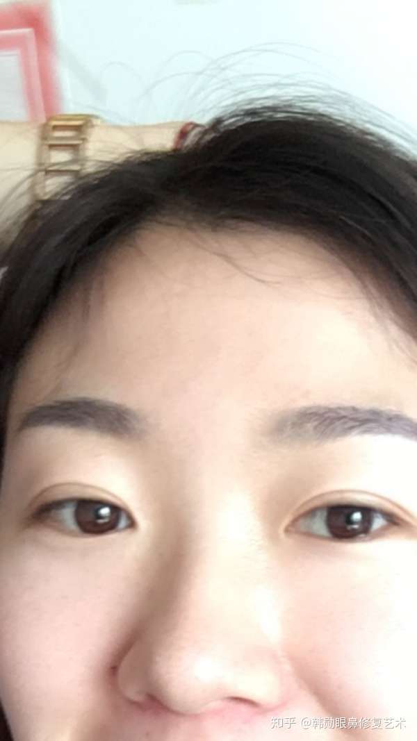 割双眼皮两三年了,肉条还这么明显,如何修复?