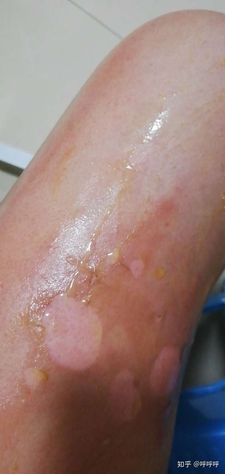 记一次烫伤经历